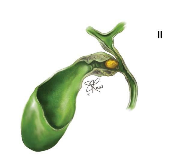 syndrome where isolation of the cystic duct might not be possible and any attempt at it risks biliary ductal injury.
