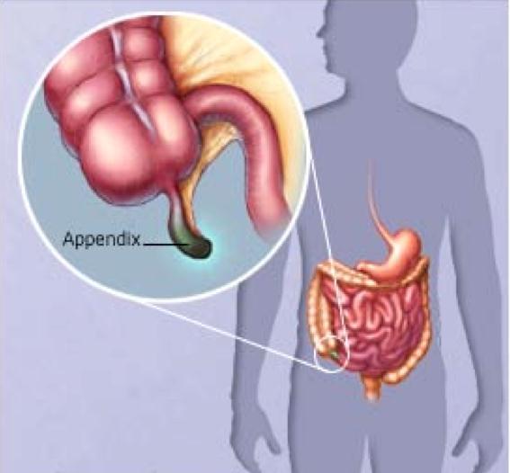 Pediatric Appendicitis Most common acute abdominal condition 70,000 per year 5-10%