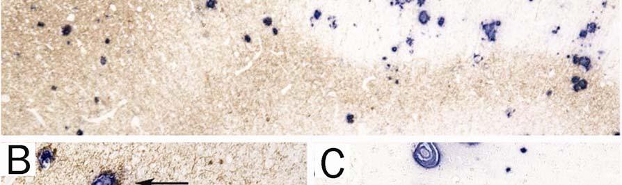 (Bar = 75 μm) C. CAA accompanied by minimal to no perivascular neuritic dystrophy in visual cortex. (Bar = 75 μm).