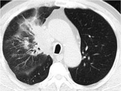 Radiation Pneumonitis NOT an acute toxicity it is delayed/subacute, usually 1-12 mo after RT Radiographic pneumonitis is common (~66%), clinic symptoms less so (10-20%) Sx: nonproductive cough,