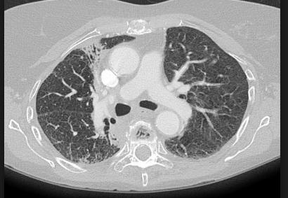 Late Radiation Toxicity Lung Fibrosis: Most clinical pneumonitis fibrosis in the region of the previous pneumonitis.