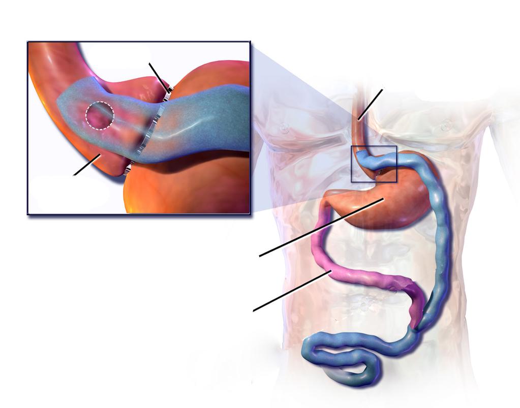 ABOUT BARIATRIC SURGERY: ROUX-EN-Y GASTRIC BYPASS Bariatric surgery changes the size of your stomach and the length of your small intestine.