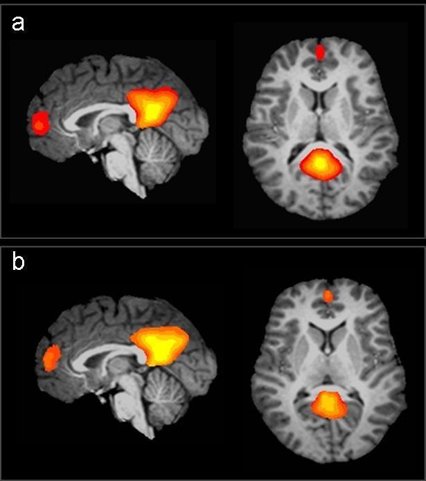 Resting-state functional connectivity (correlation) group maps (a) with and (b) without global signal regression. At threshold p<0.