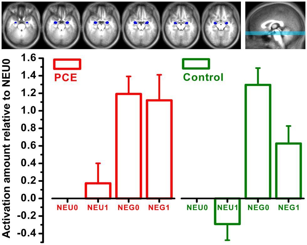 Prenatal cocaine exposure and emotional arousal in adolescents: Neuroimaging and N-Back task Bilateral amygdala area (brain images) comparing activation between Cocaine exposed and Controls (bar