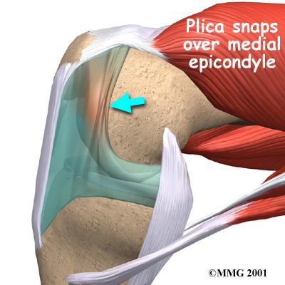 The thickened, scarred plica fold may be more likely to cause problems later. Symptoms What does plica syndrome feel like? The primary symptom caused by plica syndrome is pain.