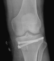Intercondylar Femur Fractures Ankle