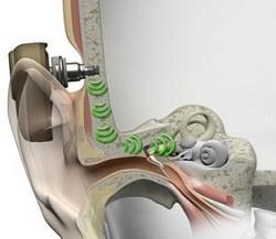 Bone-Anchored Devices Stimulation of