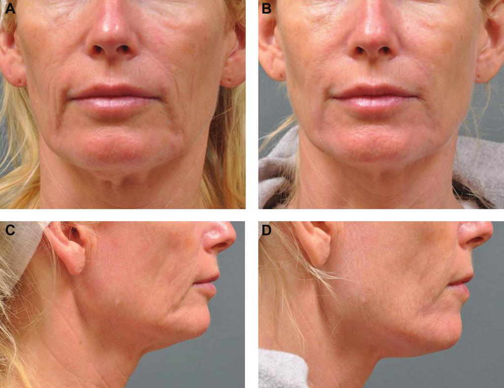 610 Aesthetic Surgery Journal 32(5) Figure 6. (A, C) This 47-year-old woman desired a noninvasive procedure to lift and tighten her anterior midface, jowls, and neck.