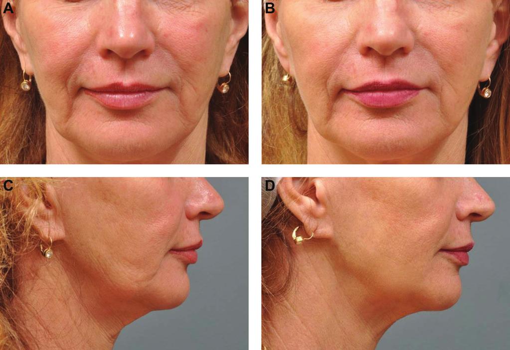 Sasaki and Tevez 611 Figure 7. (A, C) This 60-year-old woman requested a nonsurgical procedure to improve her anterior midface, pre-jowl, and neck areas.