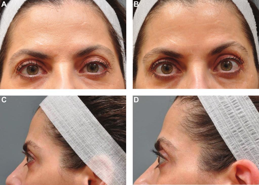 Sasaki and Tevez 603 Figure 2. (A, C) This 52-year-old woman presented with orbital hooding and ptosis of the lateral brows.