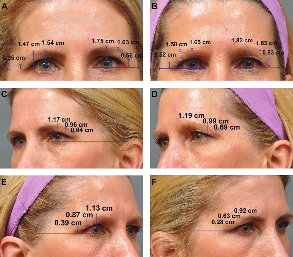 Sasaki and Tevez 607 Figure 3. (A, C, E) This 51-year-old woman presented with orbital hooding and asymmetrical ptosis of the lateral brow.