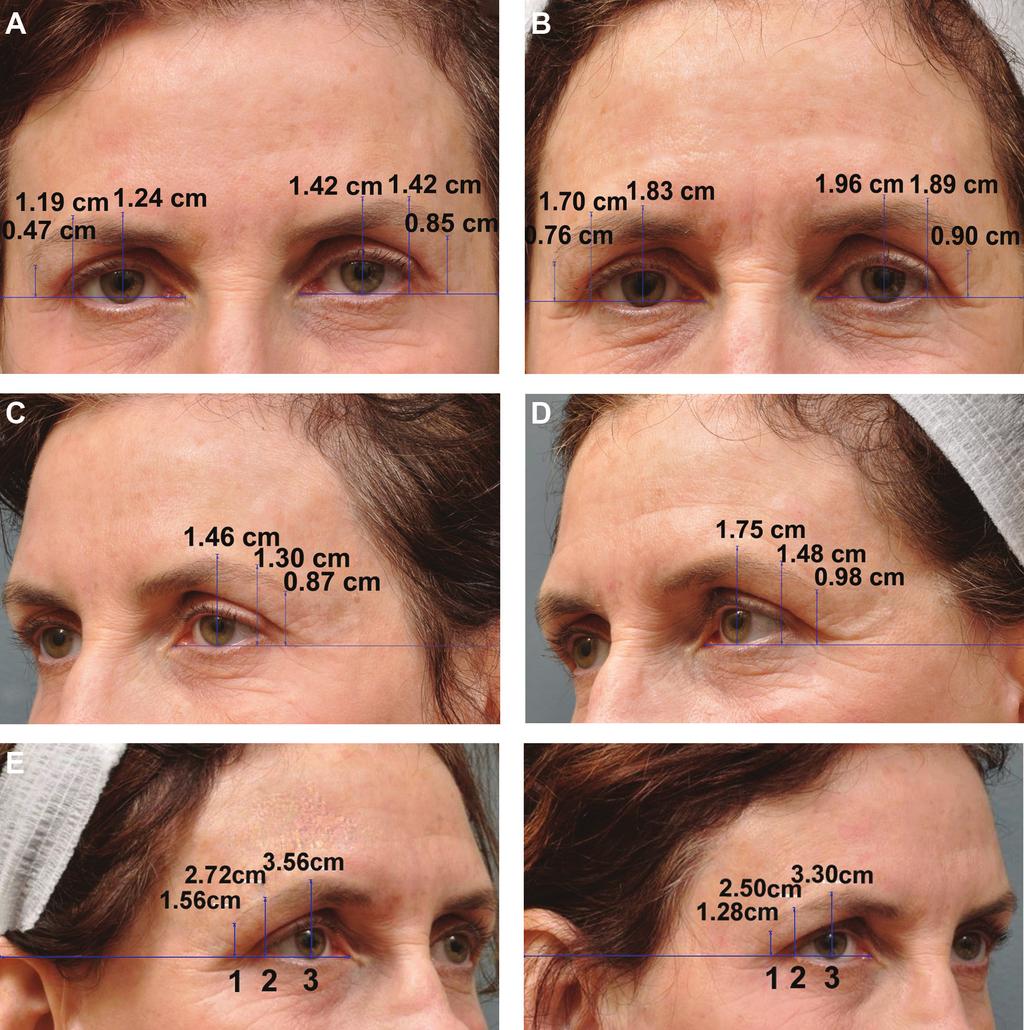 608 Aesthetic Surgery Journal 32(5) Figure 4. (A, C, E) This 65-year-old woman presented with significant orbital hooding and ptosis of the mid to lateral brows.