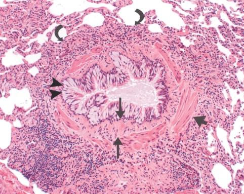 5 mm from adventitia to adventitia) with muscle hypertrophy (short straight arrow), submucosal and submembranous fibrosis (long straight arrows), and inflammatory infiltrate (curved arrows) rich in