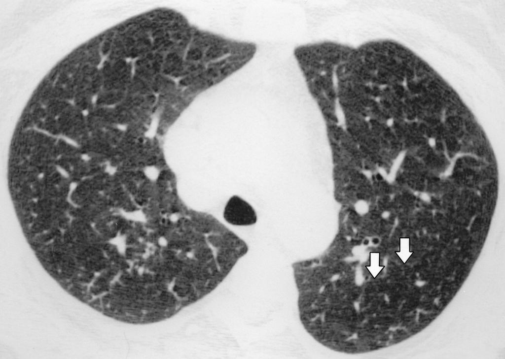 caused by fibrous tissue (arrows) and resulted in luminal narrowing. These findings are characteristic of mild constrictive bronchiolitis.