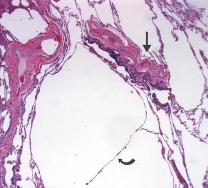 , Photomicrograph of histopathologic specimen shows strand of residual alveolar tissue (curved arrow) remaining in cyst arising adjacent to bronchiole (straight arrow).