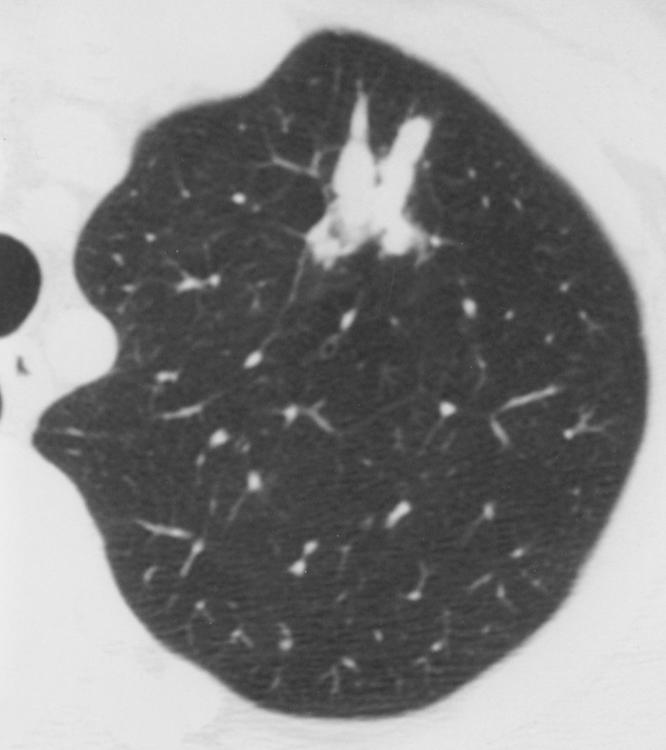 CT of sthma and ssociated Conditions Downloaded from www.ajronline.org by 46.3.194.46 on 01/23/18 from IP address 46.3.194.46. Copyright RRS. For personal use only; all rights reserved Fig. 8.