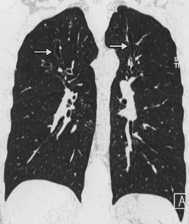 , High-resolution CT scan obtained at slightly higher level than shows that mucoid impaction is present in several small bronchi. the typical mucous plugs (allergic mucin) (Fig.