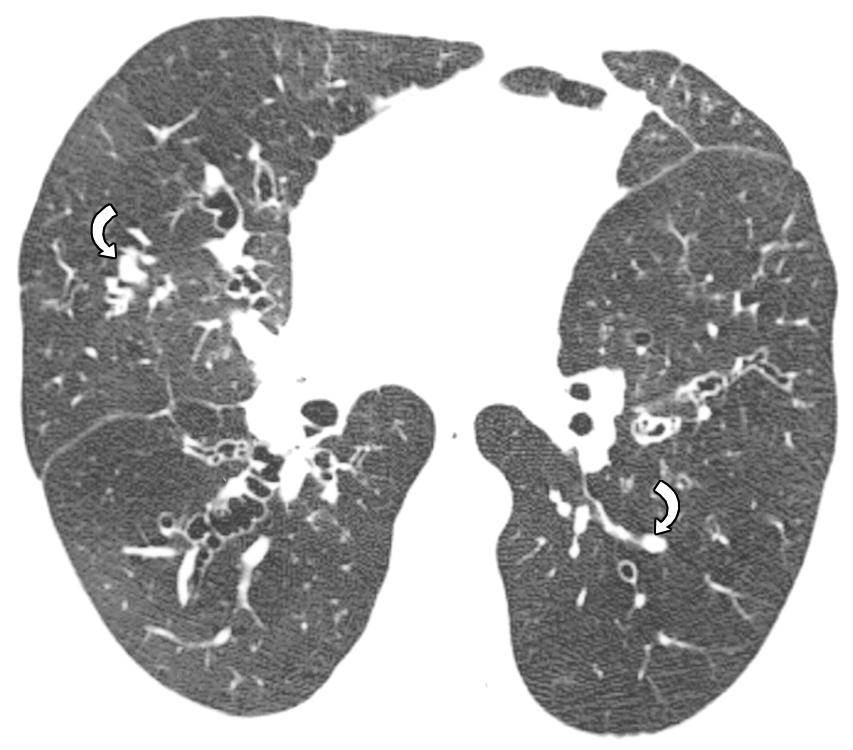 , High-resolution MDCT scan obtained through upper lobes shows severe bilateral bronchiectasis and marked bronchial wall thickening.