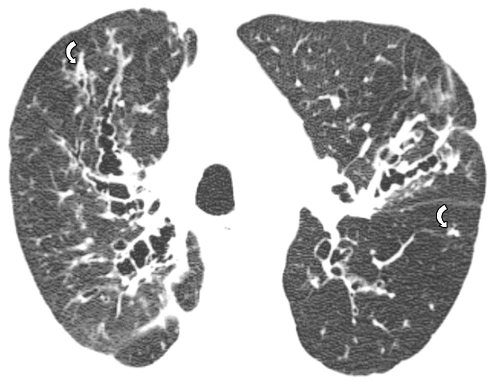 , High-resolution MDCT scan obtained at level of lower lobe bronchi shows central bronchiectasis, areas of decreased attenuation and