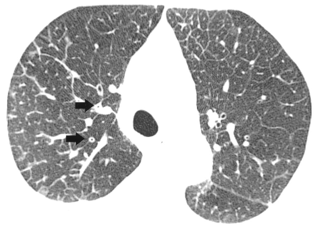 lso noted are bronchial wall thickening (arrows), small peripheral ground-glass opacities, and a small right pleural effusion.