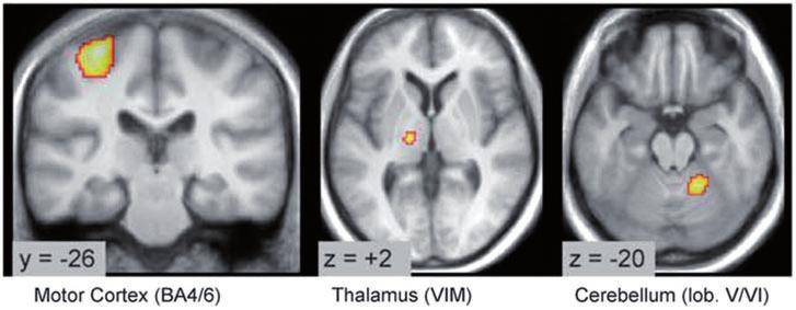 Activity was localized to the motor cortex, ventral intermediate nucleus of the thalamus and cerebellum (side contralateral to the tremor).