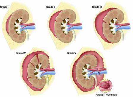 Right kidney was affected in 33 (52.4%) of patients and left kidney was affected 30 (47.6%) of patients. Most cases presents in low grade kidney trauma (Grade 1-3).