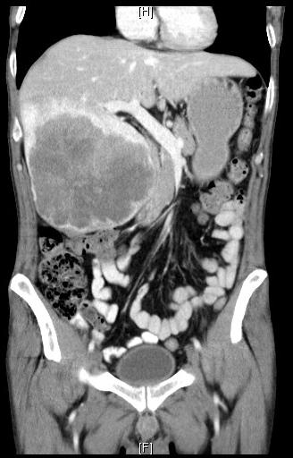 Resectable LLD but high risk of recurrence Age 51y Rectal