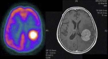 Primary CNS Lymphoma positron emission tomography very