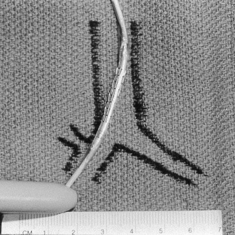 Figure 4. Bronchoscopic view of tracheal stent. Figure 2. Balloon-expandable metallic angioplasty stent loaded on angioplasty catheter for insertion. Figure 5.