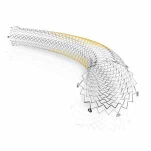 CORDIS Self-Expanding Biliary Stents S.M.A.R.T. Biliary Stent System When physicians think of nitinol stents, they think of Cordis. The S.M.A.R.T. Stents are cut from a single piece of nitinol without rough or cutting edges.