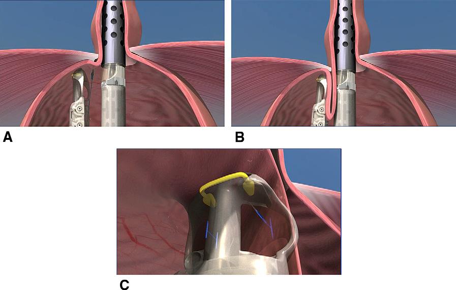 Evolving Technology/Basic Science FIGURE 2. A, Helical retractor retracting the Z-line into the tissue mold. B, Tissue mold closed to approximate the fundus to the intra-abdominal esophagus.