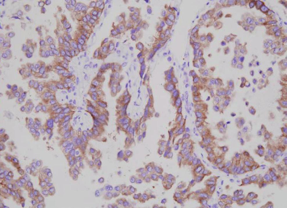 There are still several considerations regarding the use of ALK IHC as a screening method for ALK rearrangement. First of all, there is no accepted standard criterion for IHC interpretation.