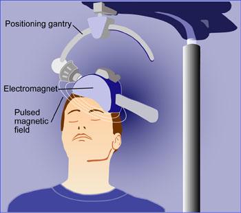Pipeline Motor symptoms Repetitive Transcranial magnetic stimulation (rtms)