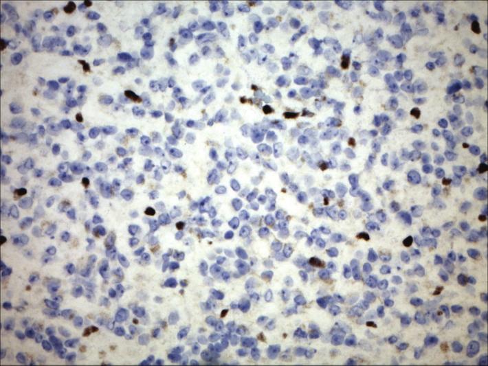 (b) Loss of INI-1 expression of the neoplastic cells by immunohistochemistry staining confirms the diagnosis of ATRT (40x).