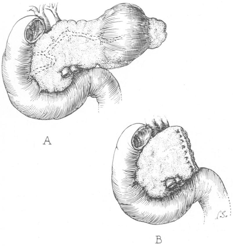672 CAMERON, BRAWLEY, BENDER AND ZUIDEMA A B FIG. 3A. Small mass present in the tail of the pancreas of Patient 2 with surrounding edema and induration. B. Distal pancreas including pseudocyst resected and end of gland oversewn.