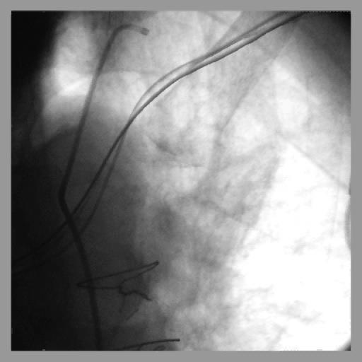Coronary Angiogram Patent LIMA Patent SVG to