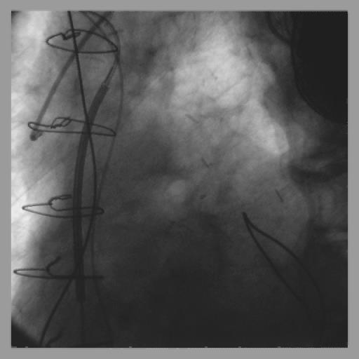stenosis No significant disease in RCA