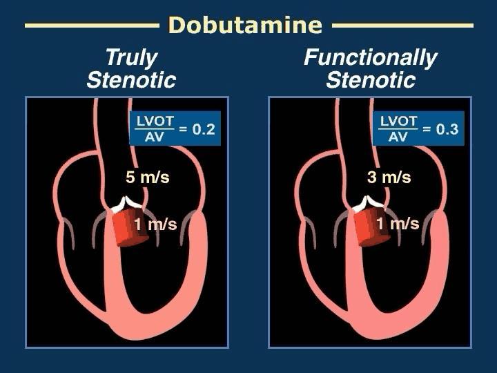 Dobutamine in Low Gradient- Low EF Aortic Stenosis True severe AS SV, transvalvular gradient; No change