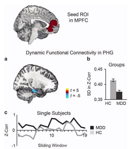 Dynamic connectivity in MDD Decreased dynamic connectivity within default network in MDD