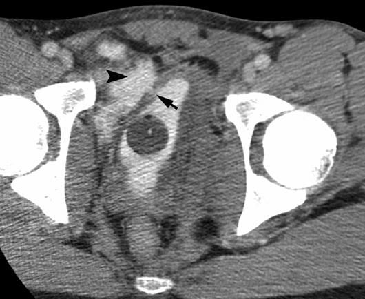 T ystography for Suspected ladder Rupture bladder rupture is suspected, especially when water-dense fluid is seen in the peritoneal cavity, T cystography is indicated.