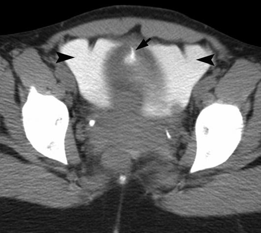 han et al. Fig. 2 34-year-old woman with intraperitoneal bladder rupture after motor vehicle collision.