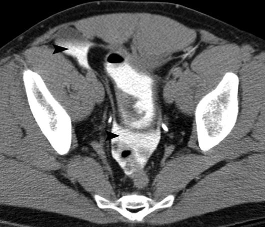 T ystography for Suspected ladder Rupture Fig. 3 29-year-old man with intraperitoneal bladder rupture who was struck by motor vehicle.
