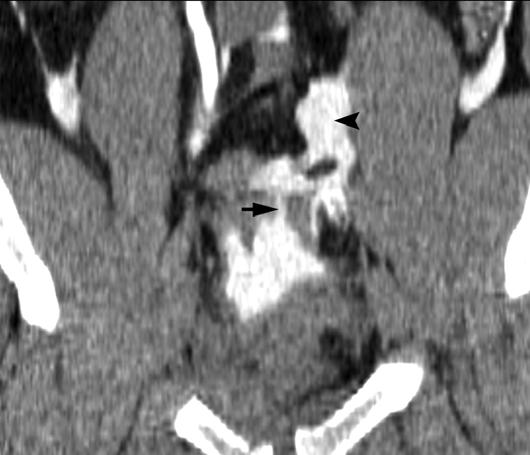 and, oronal () and sagittal () T cystography images show site of bladder rupture at dome (arrows) with contrast extravasation into peritoneal space (arrowheads).