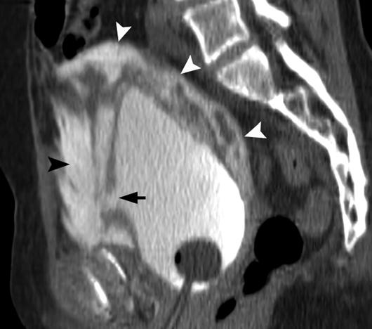 8%) of 18 had pelvic fracture; 11 patients had extraperitoneal bladder rupture, one patient had intraperitoneal rupture, and two patients had combined intraperitoneal and extraperitoneal rupture.