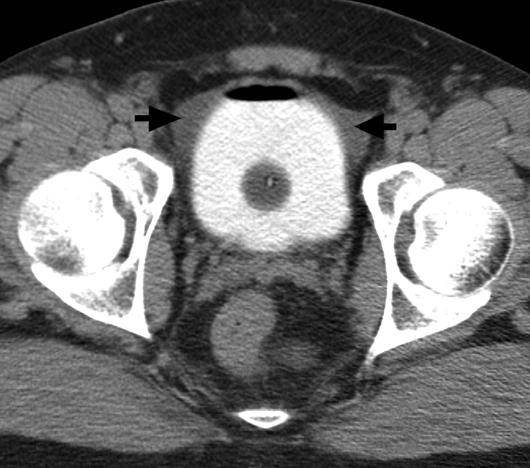 , xial T cystography image at bladder level shows a small amount of fluid lateral to bladder but no contrast extravasation is seen (arrows).