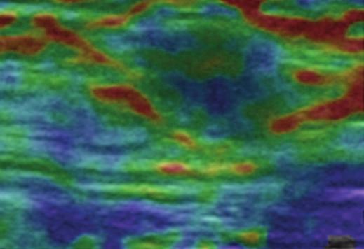 A We reviewed the static elastography images to assess interobserver variability according to the interpretational differences in identical elastographic images.