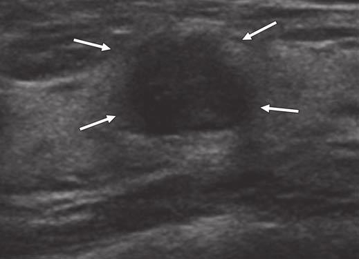Elastography of Breast Lesions Downloaded from www.ajronline.org by 46.3.21.182 on 1/24/18 from IP address 46.3.21.182. Copyright ARRS.