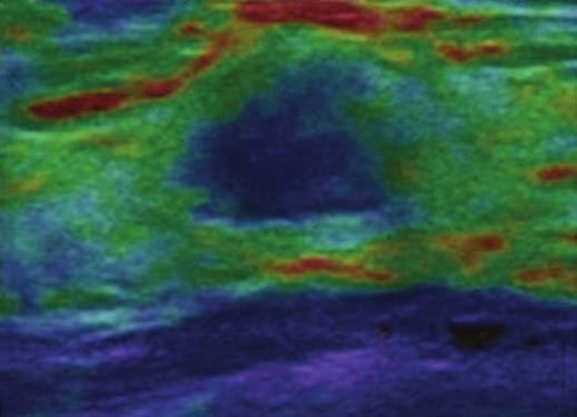 We applied the subdivisions of category 4 in BI-RADS assessment of breast lesions, and, as in the previous studies, this may have lessened the agreement of ultrasound and combined ultrasound and