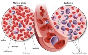 Acute Myeloid Leukemia Market Opportunity 1 AML: aggressive hematologic malignancy Incidence: 20,000* new cases and 10,400 deaths annually in the U.S.