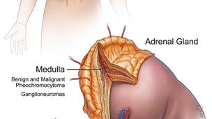Adrenocortical Carcinoma (ACC) Market Opportunity Adrenocortical carcinoma (ACC) is a rare cancer with significant unmet clinical needs Incidence: 0.